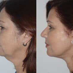 Deep Plane Facelift Before and After Photos in Miami, FL, Patient 19158