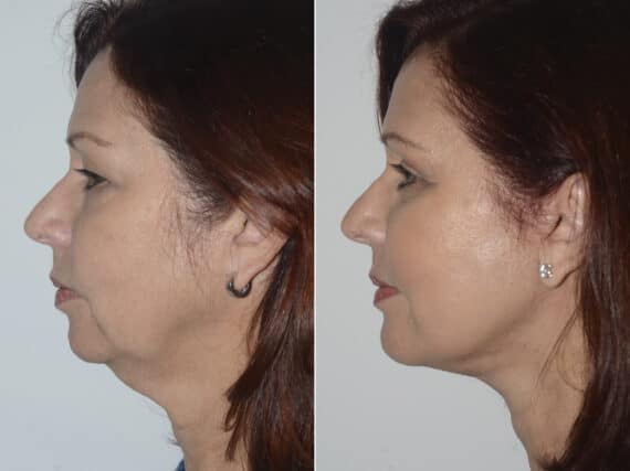 Deep Plane Facelift Before and After Photos in Miami, FL, Patient 19158