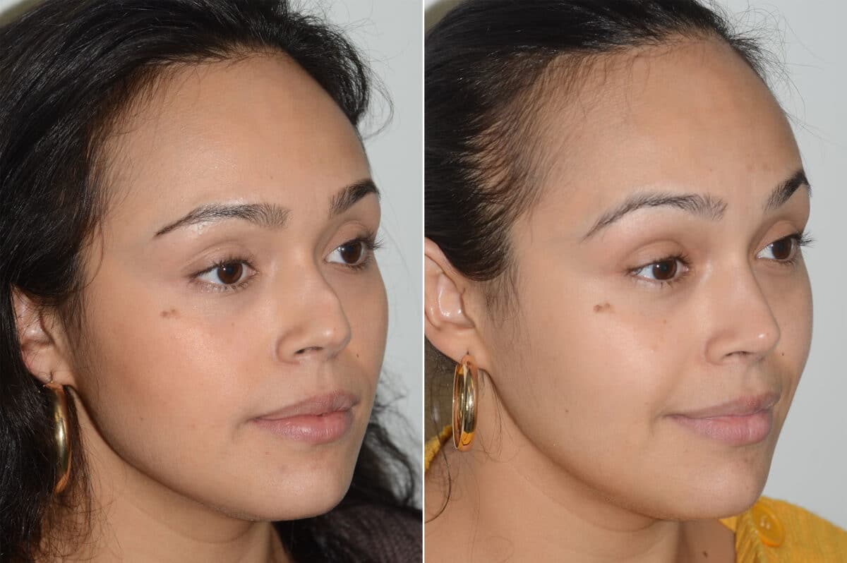 Revision Rhinoplasty Before and After Photos in Miami, FL, Patient 19201