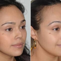 Revision Rhinoplasty Before and After Photos in Miami, FL, Patient 19201