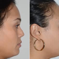 Revision Rhinoplasty Before and After Photos in Miami, FL, Patient 19201