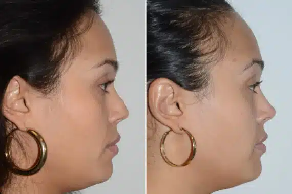 Revision Rhinoplasty Before and After Photos in Miami, FL, Patient 19201