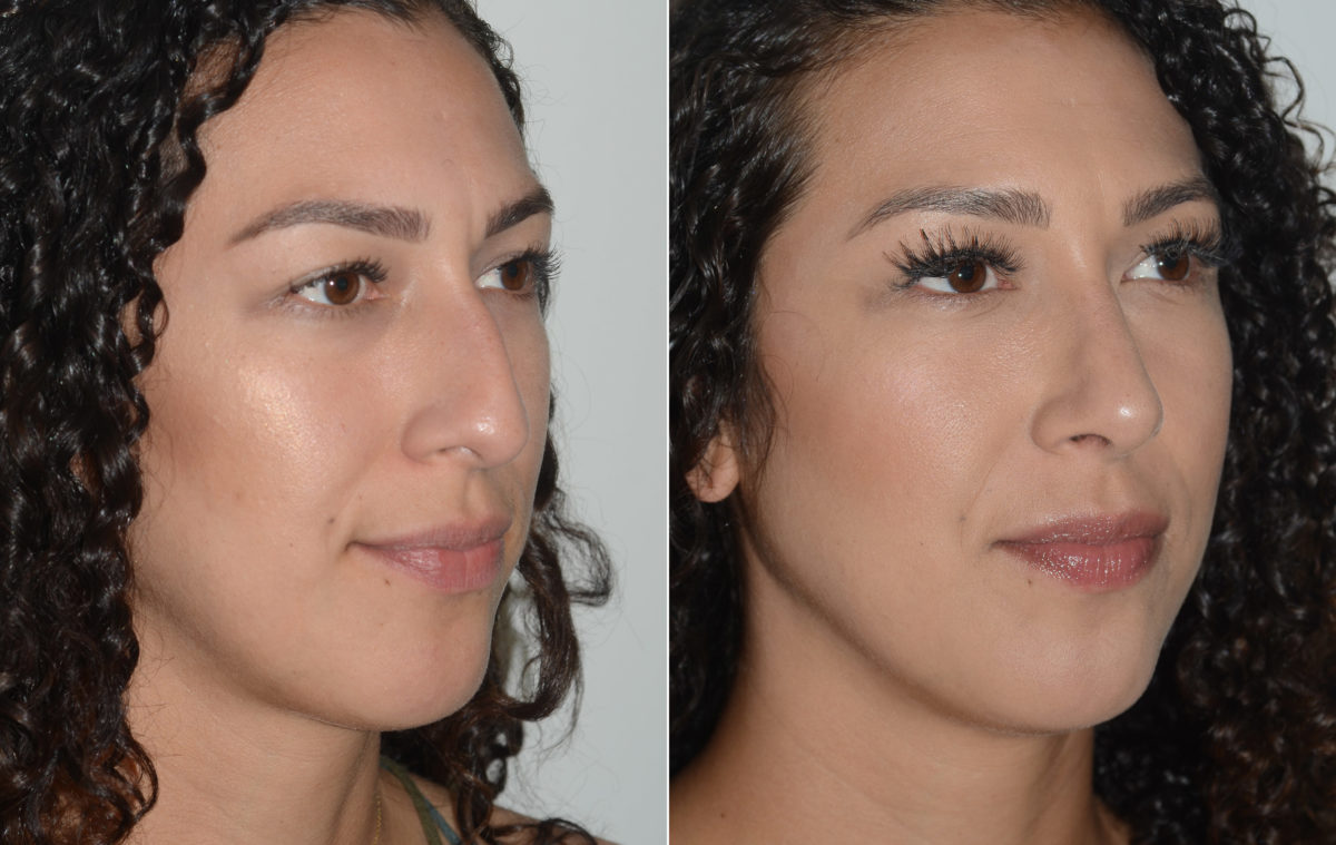 Rhinoplasty Before and After Photos in Miami, FL, Patient 19463