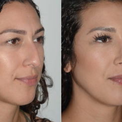 Rhinoplasty Before and After Photos in Miami, FL, Patient 19463