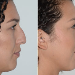 Rhinoplasty Before and After Photos in Miami, FL, Patient 19463
