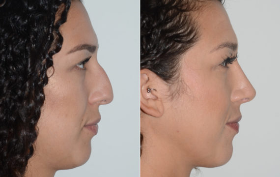 Rhinoplasty Before and After Photos in Miami, FL, Patient 19463