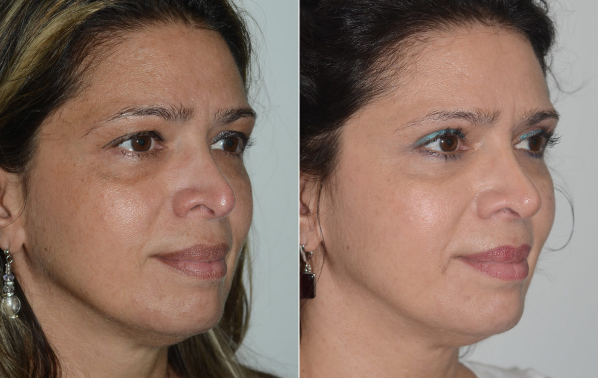 Revision Rhinoplasty Before and After Photos in Miami, FL, Patient 19477