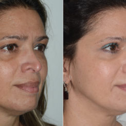 Revision Rhinoplasty Before and After Photos in Miami, FL, Patient 19477