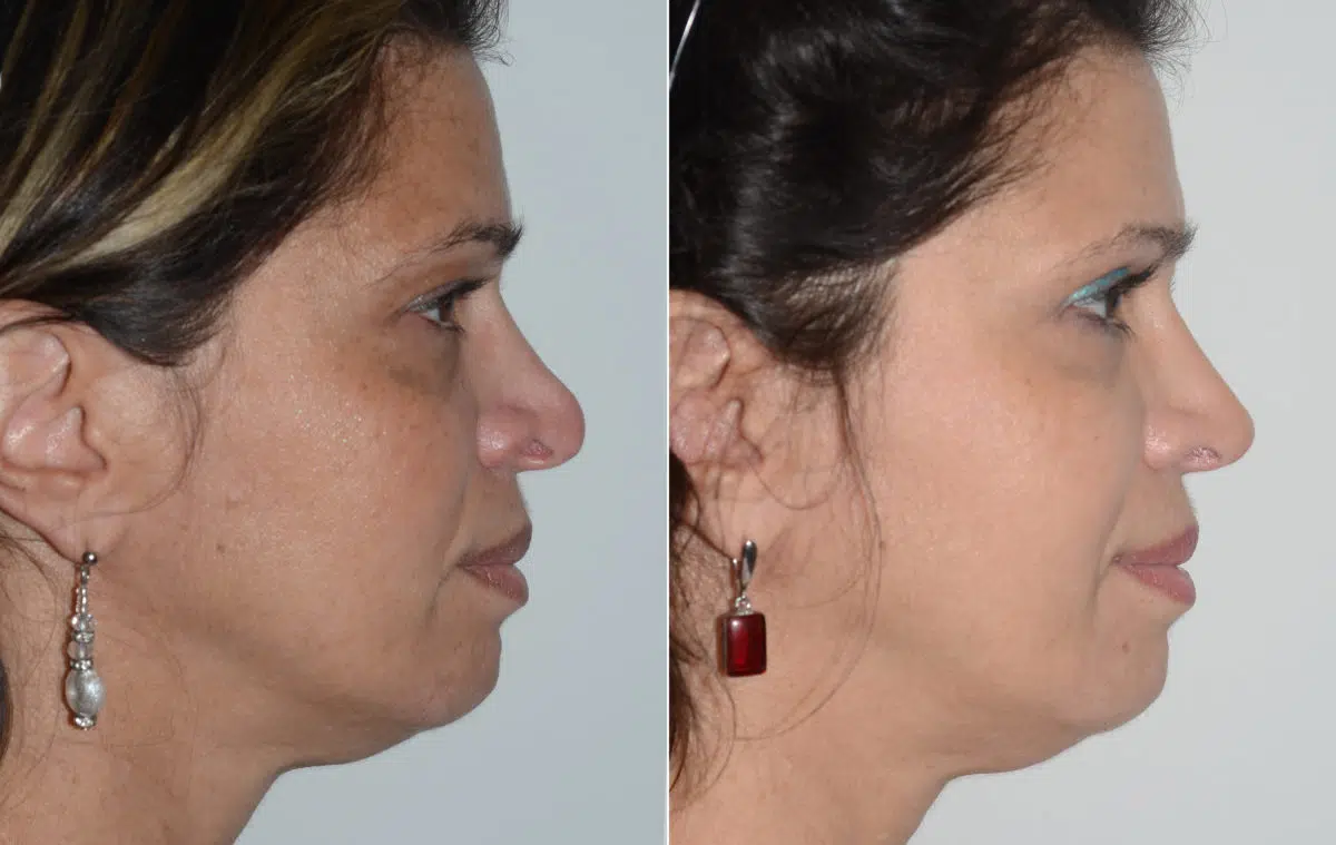 Revision Rhinoplasty Before and After Photos in Miami, FL, Patient 19477