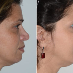 Revision Rhinoplasty Before and After Photos in Miami, FL, Patient 19477