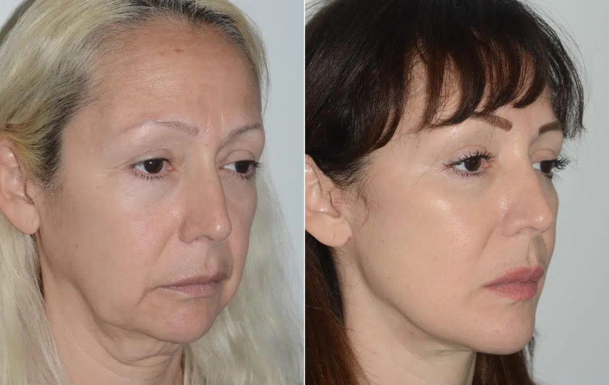 Deep Plane Facelift Before and After Photos in Miami, FL, Patient 19487