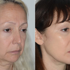 Deep Plane Facelift Before and After Photos in Miami, FL, Patient 19487
