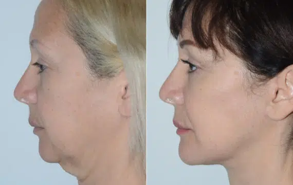 Deep Plane Facelift Before and After Photos in Miami, FL, Patient 19487