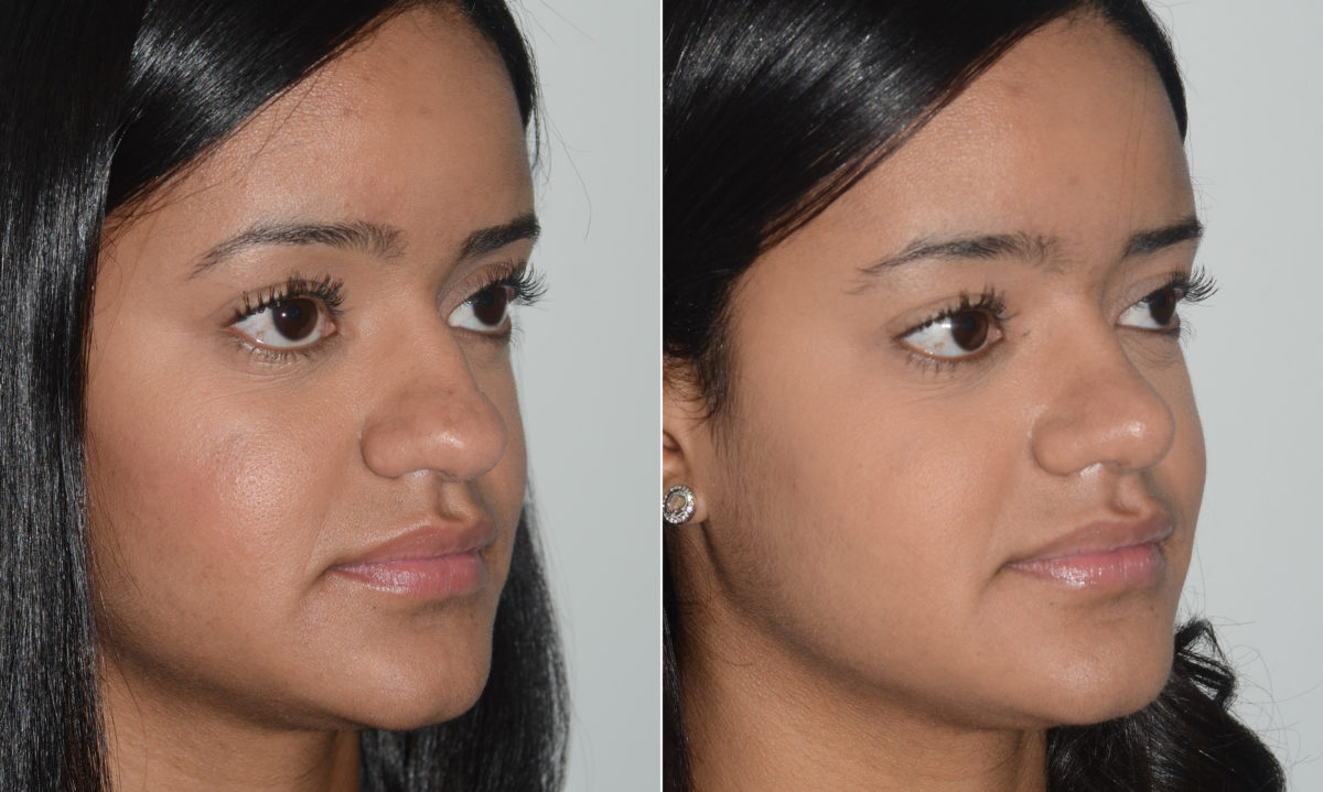 Rhinoplasty Before and After Photos in Miami, FL, Patient 19588