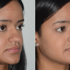 Rhinoplasty Before and After Photos in Miami, FL, Patient 19588