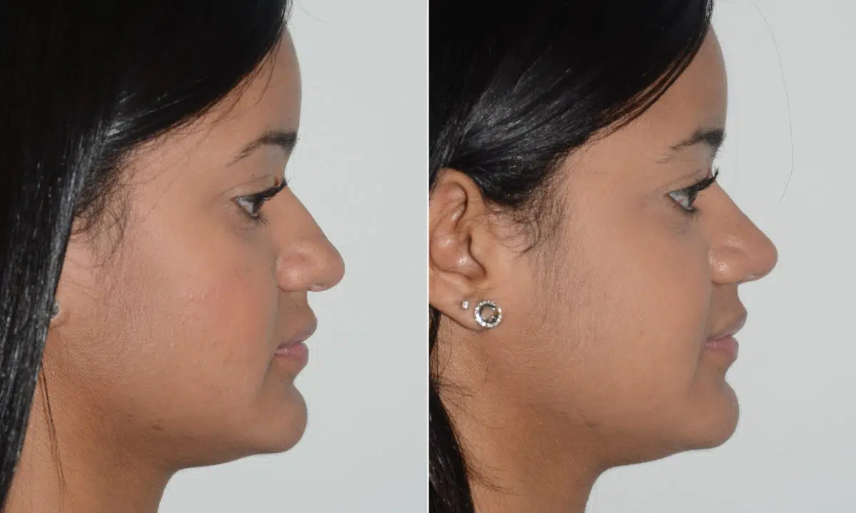 Rhinoplasty Before and After Photos in Miami, FL, Patient 19588