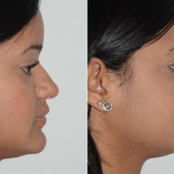 Rhinoplasty Before and After Photos in Miami, FL, Patient 19588