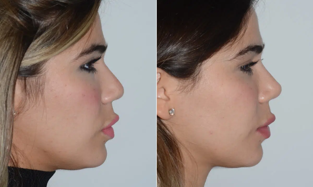 Rhinoplasty Before and After Photos in Miami, FL, Patient 19722