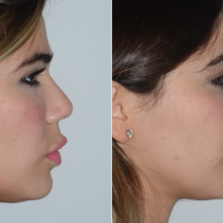 Rhinoplasty Before and After Photos in Miami, FL, Patient 19722