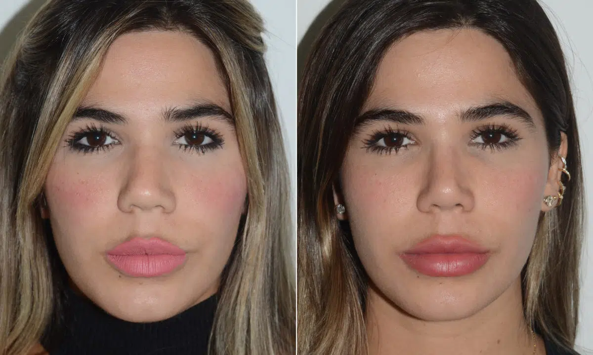 Rhinoplasty Before and After Photos in Miami, FL, Patient 19722