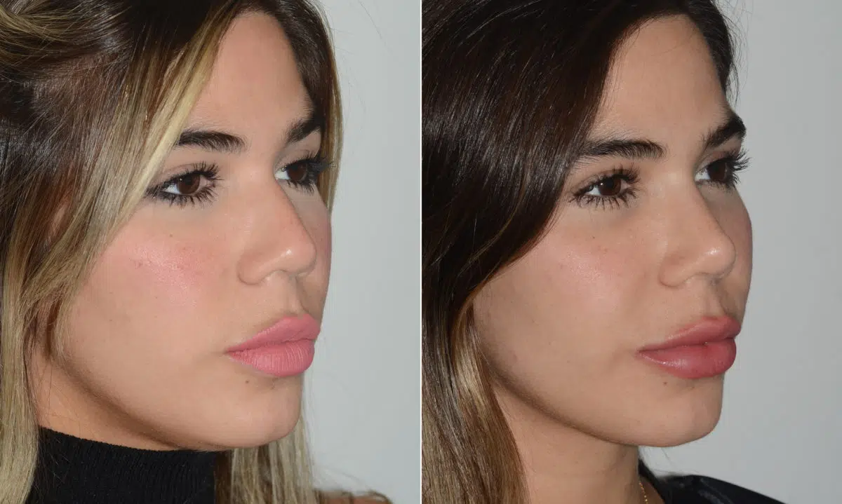 Rhinoplasty Before and After Photos in Miami, FL, Patient 19722