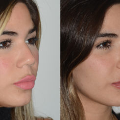 Rhinoplasty Before and After Photos in Miami, FL, Patient 19722