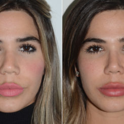 Rhinoplasty Before and After Photos in Miami, FL, Patient 19722