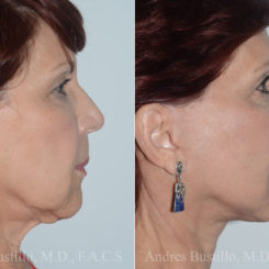 Deep Plane Facelift Before and After Photos in Miami, FL, Patient 19744