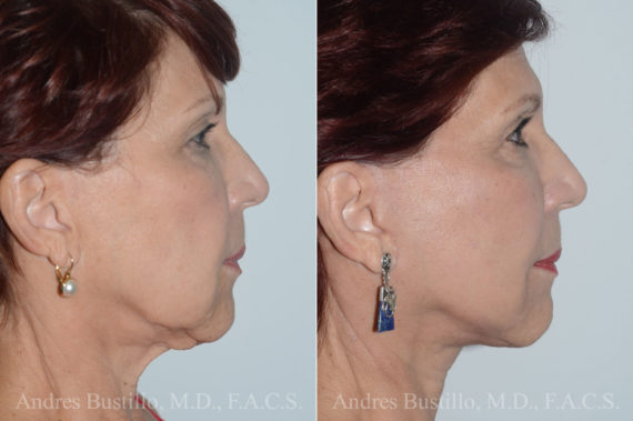 Deep Plane Facelift Before and After Photos in Miami, FL, Patient 19744