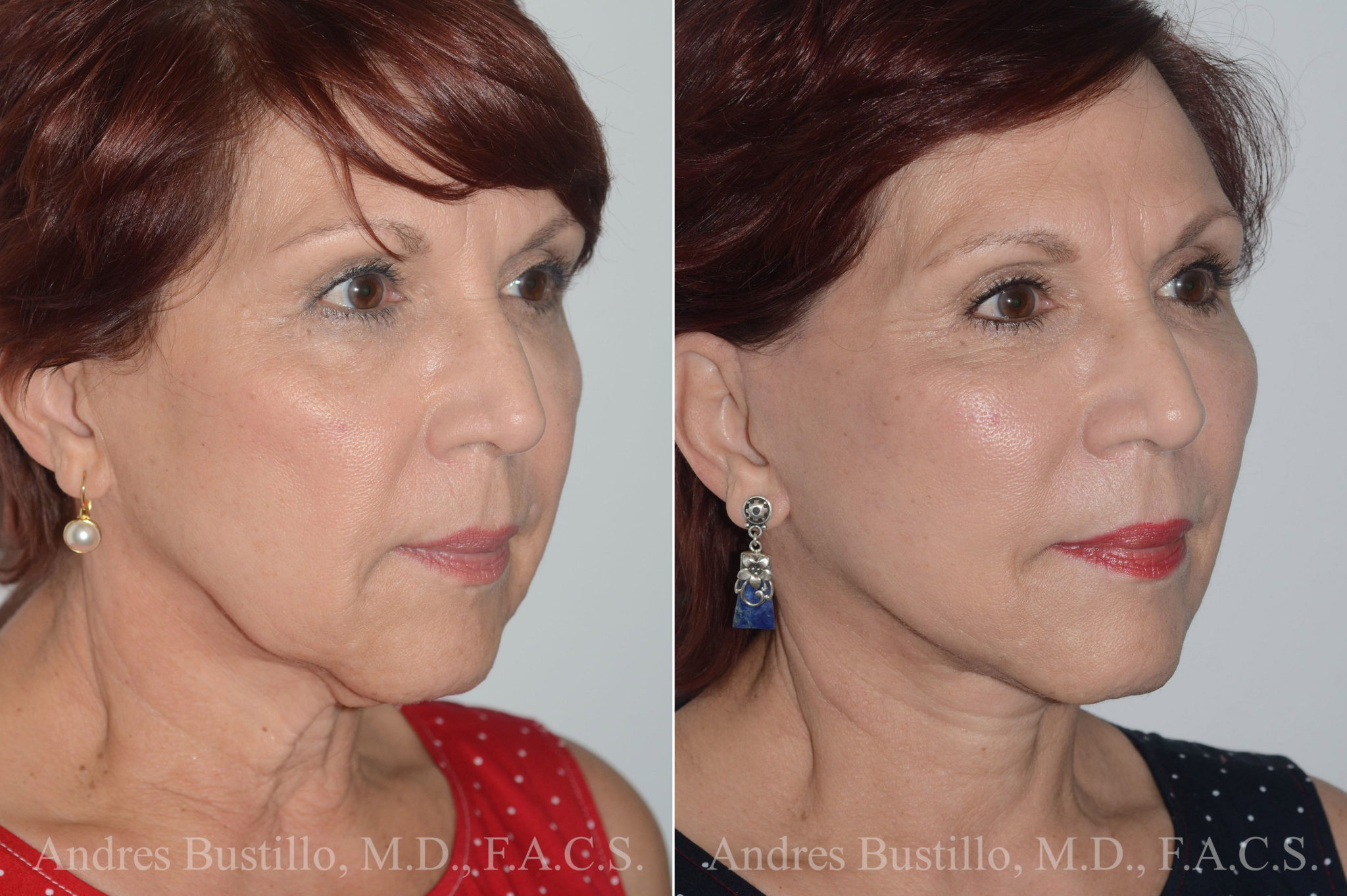 Deep Plane Facelift photos Miami, FL. Patient 19744