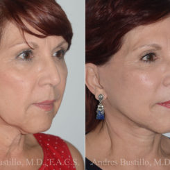 Deep Plane Facelift Before and After Photos in Miami, FL, Patient 19744