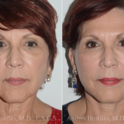 Deep Plane Facelift Before and After Photos in Miami, FL, Patient 19744
