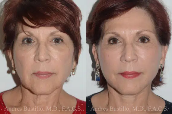 Deep Plane Facelift Before and After Photos in Miami, FL, Patient 19744