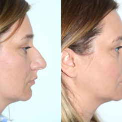 Rhinoplasty Before and After Photos in Miami, FL, Patient 19800