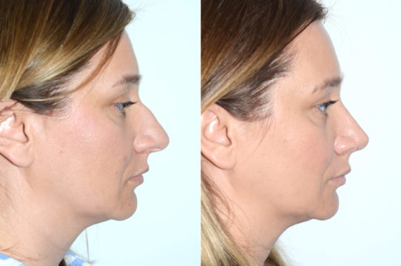 Rhinoplasty Before and After Photos in Miami, FL, Patient 19800