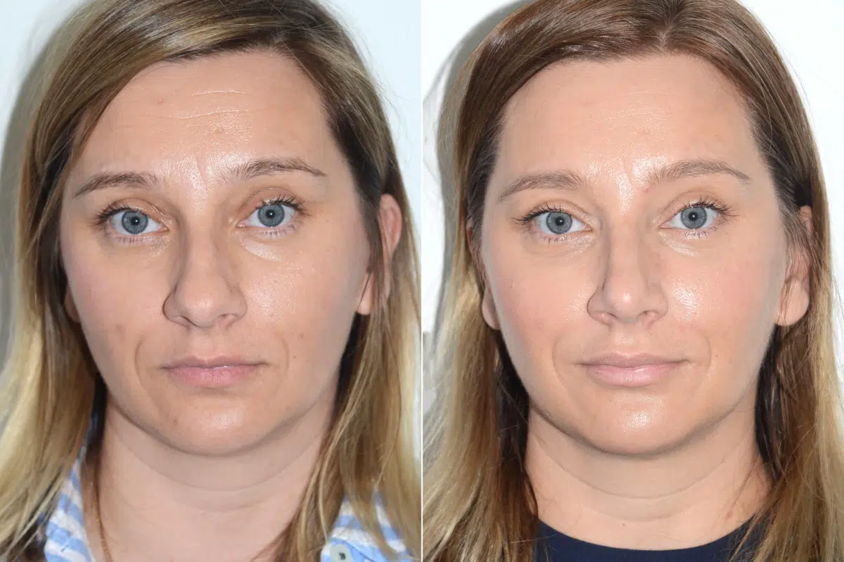 Rhinoplasty Before and After Photos in Miami, FL, Patient 19800