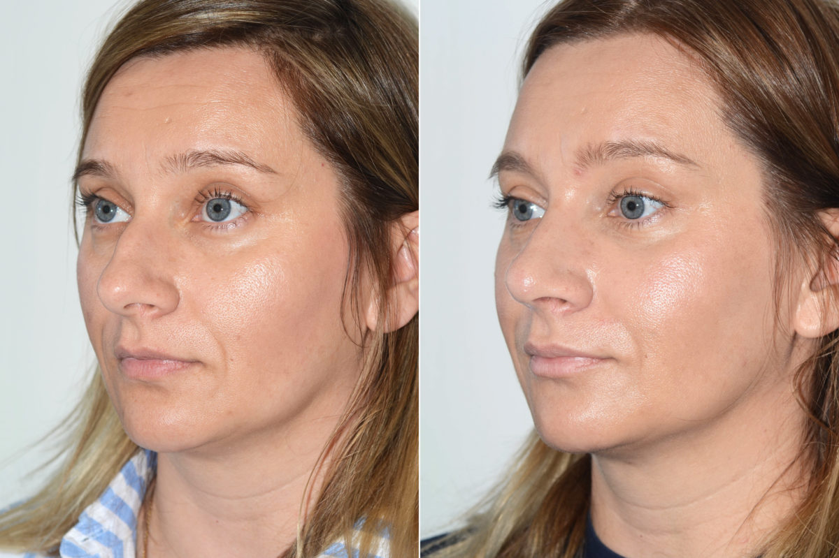 Rhinoplasty Before and After Photos in Miami, FL, Patient 19800