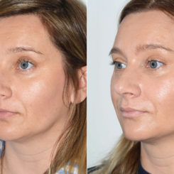 Rhinoplasty Before and After Photos in Miami, FL, Patient 19800