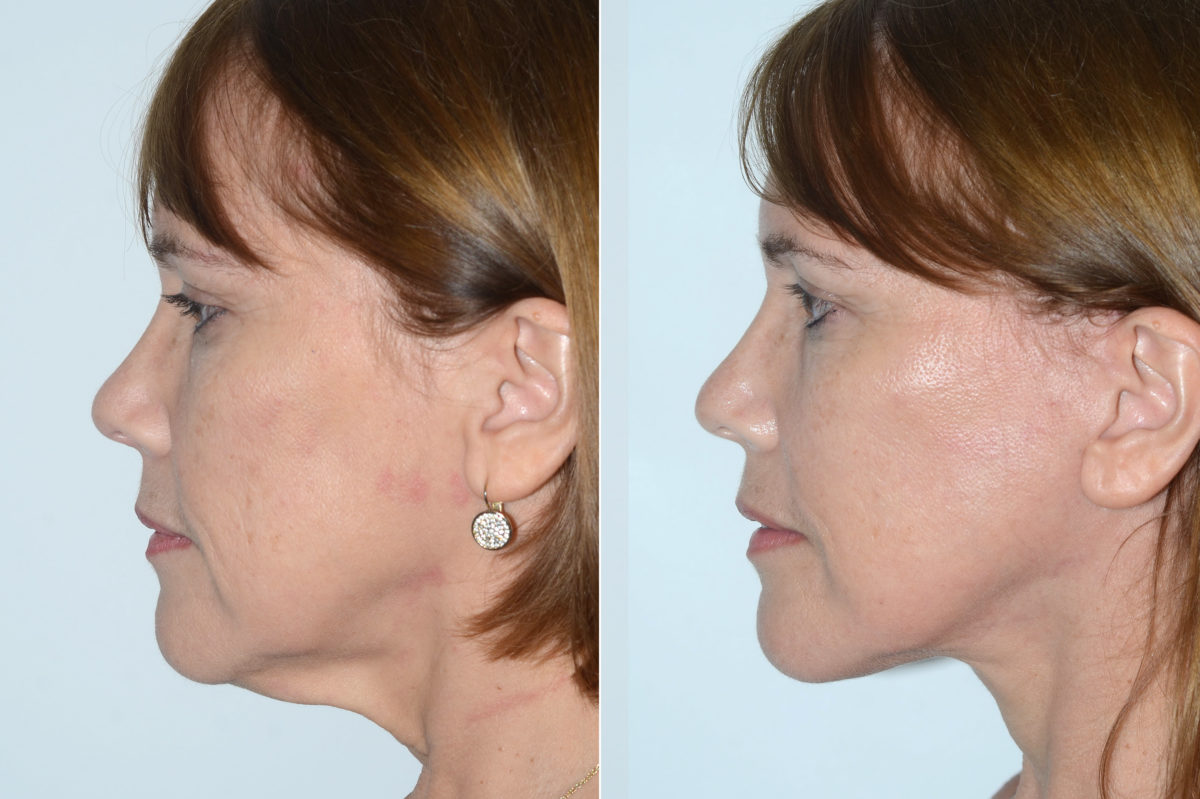 Deep Plane Facelift Before and After Photos in Miami, FL, Patient 19891