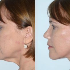 Deep Plane Facelift Before and After Photos in Miami, FL, Patient 19891