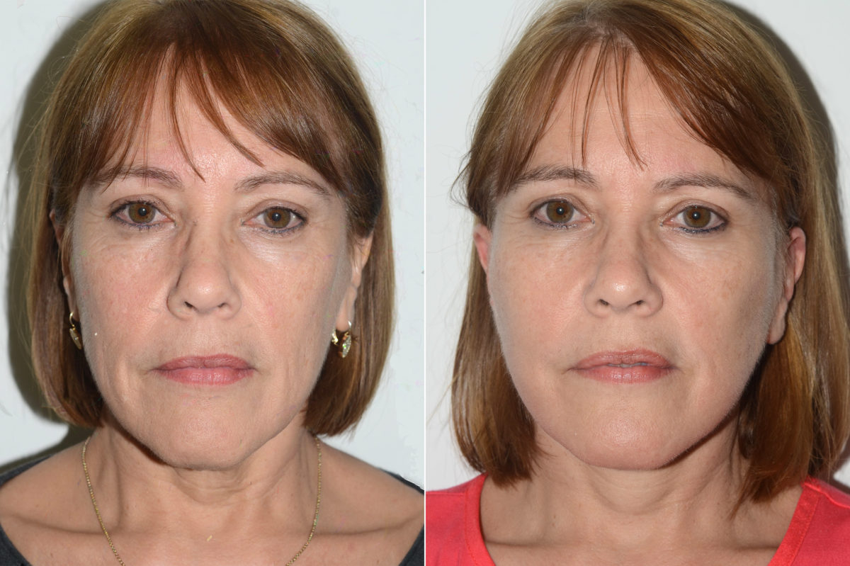 Deep Plane Facelift Before and After Photos in Miami, FL, Patient 19891