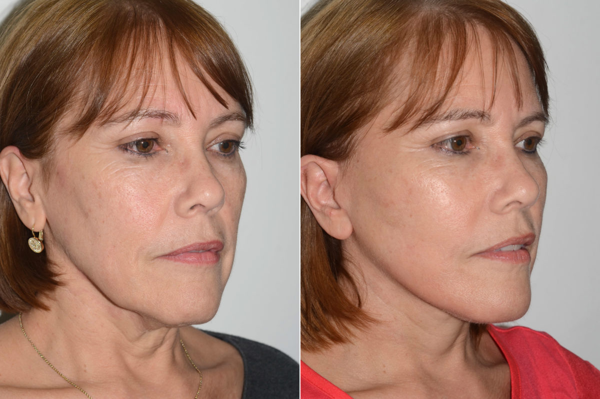 Deep Plane Facelift Before and After Photos in Miami, FL, Patient 19891