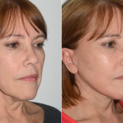 Deep Plane Facelift Before and After Photos in Miami, FL, Patient 19891