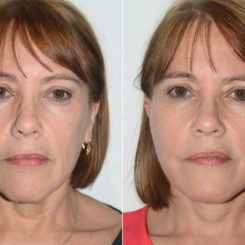 Deep Plane Facelift Before and After Photos in Miami, FL, Patient 19891