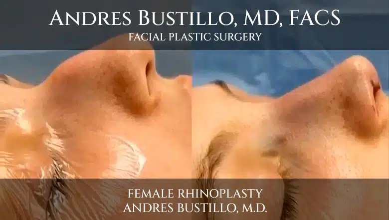 Rhinoplasty Surgery on a Female Patient performed by Andres Bustillo, M.D.