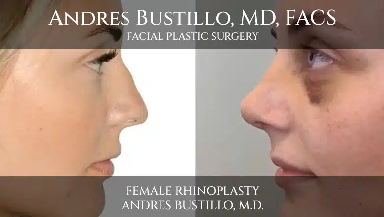 Rhinoplasty Surgery on a Female Patient performed by Andres Bustillo, M.D.