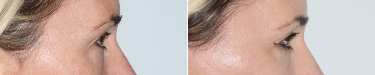 Blepharoplasty (eyelids) Before and After Photos in Miami, FL, Patient 19960