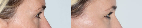 Blepharoplasty (eyelids) Before and After Photos in Miami, FL, Patient 19960