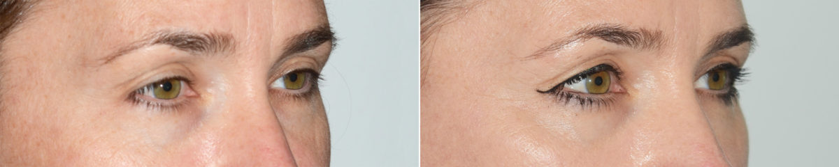 Blepharoplasty (eyelids) Before and After Photos in Miami, FL, Patient 19960
