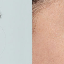 Blepharoplasty (eyelids) Before and After Photos in Miami, FL, Patient 19960